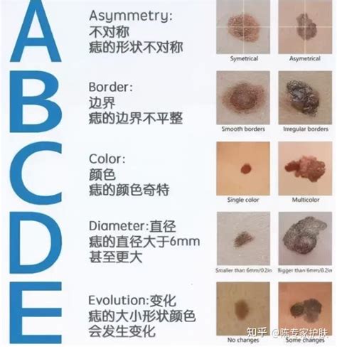 痣 顏色|痣有4種顏色，出現在「手腳這邊」的痣可能是皮膚。